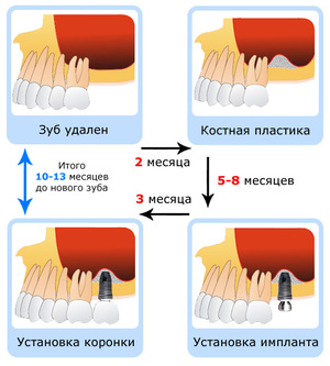 Проведение костной пластики