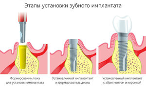 Хирургический этап имплантации