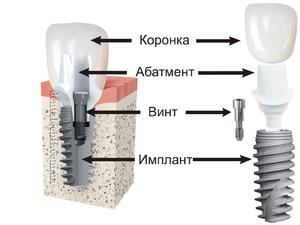 Что собой представляет абатмент
