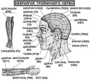Как лечить невралгию