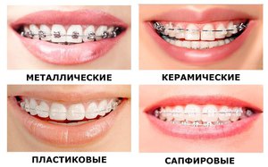 Брекеты  на зубах верхней и нижней челюсти