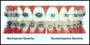 Брекеты лигатурные  на зубах 