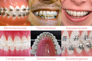Какие существуют брекеты