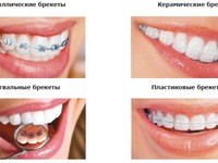 Особенности брекетов