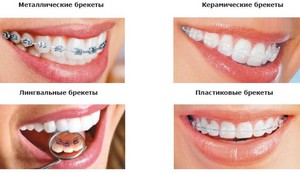 Особенности брекетов