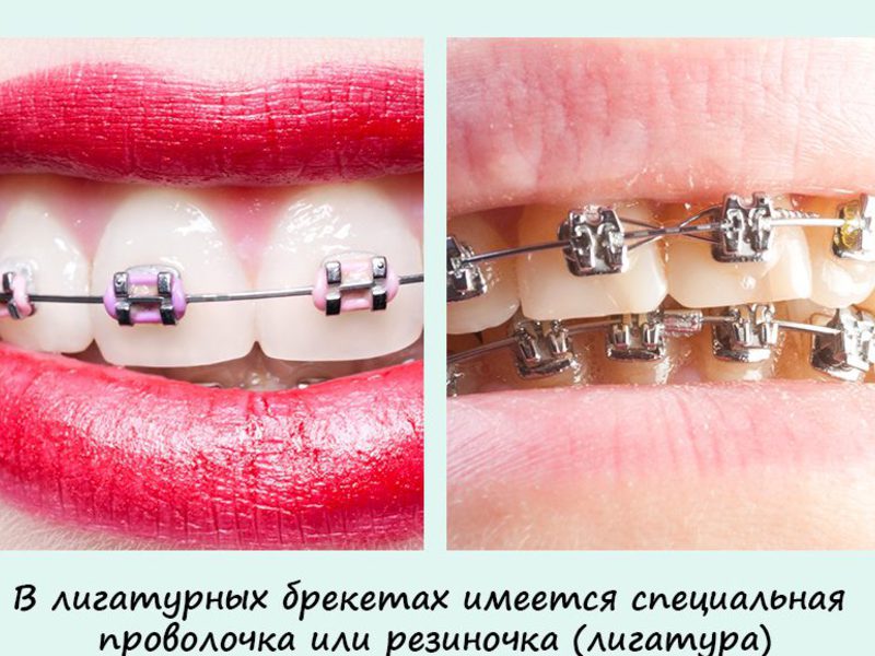Зубные брекеты Металлические брекеты
