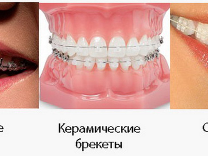 Установка брекетов Как носить брекеты