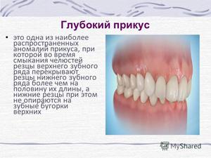 Способы исправления прикуса