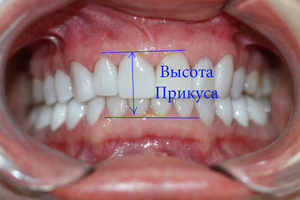 Глубокий прикус 