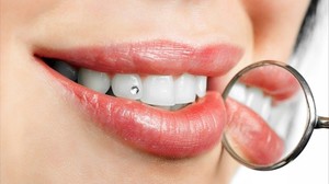 Скайсы на зубах: преимущества и недостатки