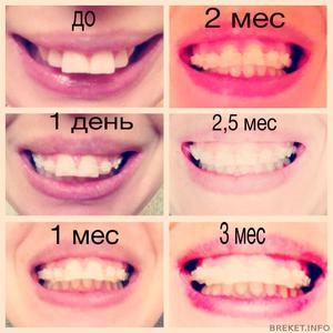 Неправильный прикус у подростков