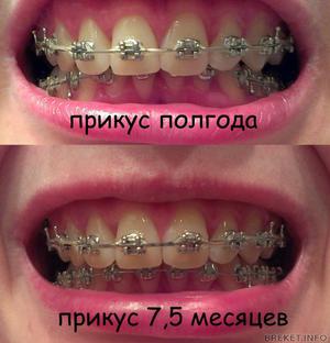 Причины дистального прикуса