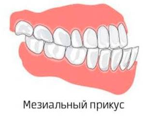 Мезиальный прикус — патология в зубочелюстной системе