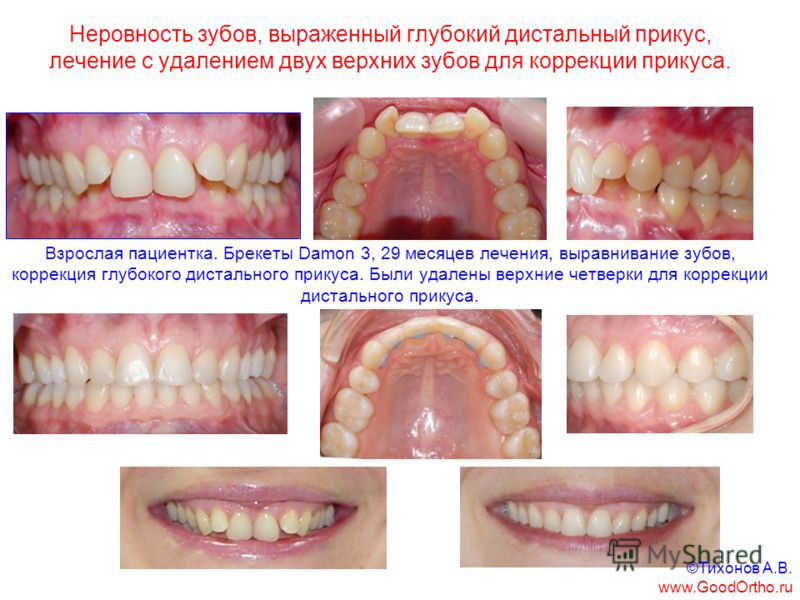 Дистальный прикус причины Лечение прикуса