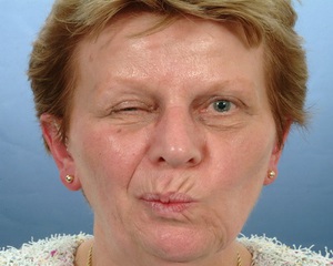 Возможные осложнения невралгии лицевого нерва