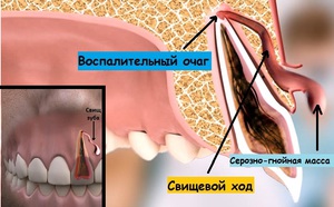 Как лечить свищ на десне