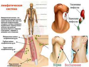 Увеличение подчелюстных лимфоузлов