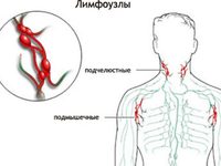 Причины воспаления лимфоузлов