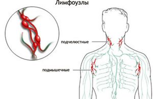 Причины воспаления лимфоузлов