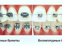 Разновидности зубных брекетов
