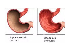 Гастрит и его лечение
