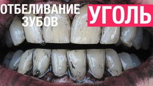 Способ отбеливания зубов