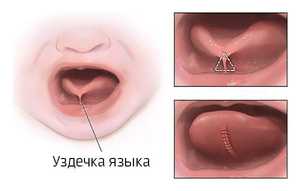 Как подрезают уздечку под языком