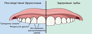 Последствия бруксизма