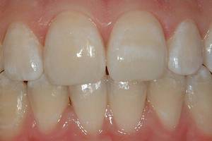 Гипоплазия эмали и ее причины