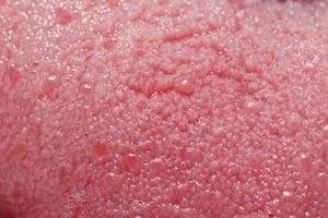 Лечение глоссита