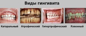 Виды гингивита