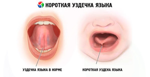 Когда надо подрезать уздечку