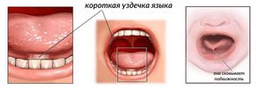 Нужно ли подрезать уздечку под языком