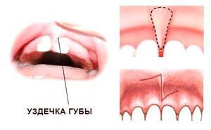 Способы удаления уздечки