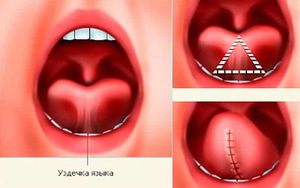 Какие есть методы удаления уздечки