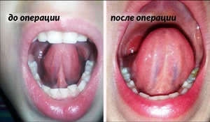 Хирургический метод удаления уздечки