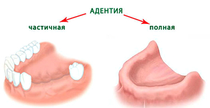 Адентия 