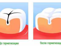 Герметизация фиссур
