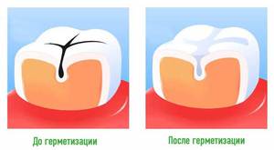 Герметизация фиссур