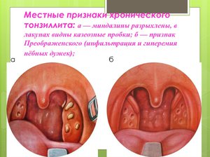 Почему появляются казеозные пробки