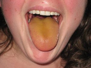 Желтый налет на языке