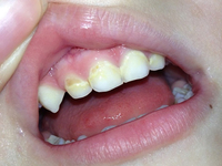 Причины флюороза у детей