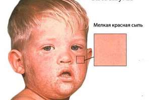 Краснуха
