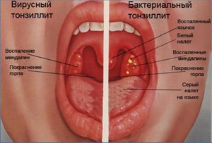 Как лечить больное горло