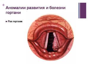Причины заболеваний горла