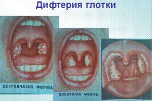 Развития заболеваний горла