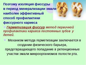 Методика герметизации зубов