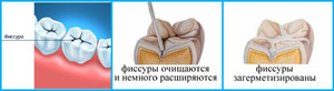 Профессиональная герметизация  зубов