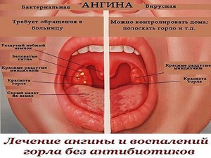 Заболевания горла