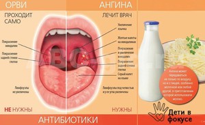 Гнойники в горле